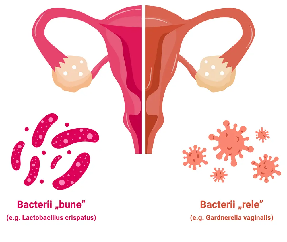 Ilustrație a aparatului reproductiv feminin: partea stângă sănătoasă, cu bacterii „bune” Lactobacillus, partea dreaptă afectată de bacterii „rele” precum Gardnerella vaginalis.